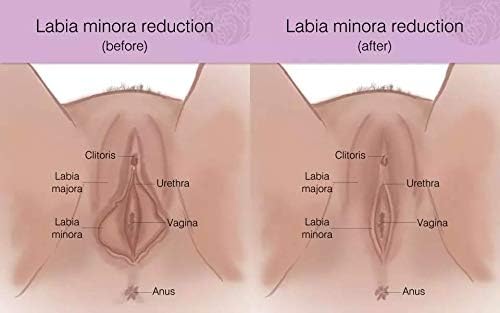 Vaginal Tightening Rejuvenation Device