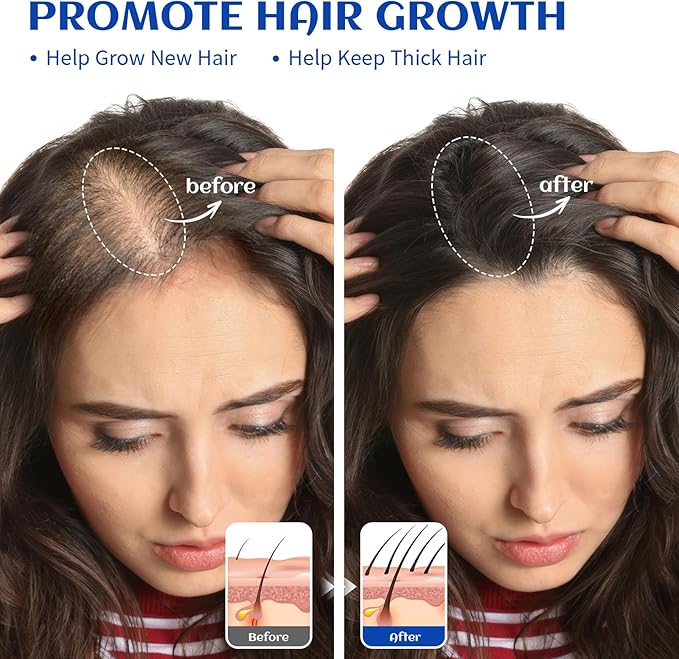 HIQILI Rosemary Oil for Hair Growth, Skin, Scalp, 100% Pure Natural, Add to Shampoo & Conditioner - 0.33 Fl Oz/10 ML - Bloomnest