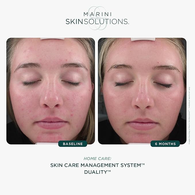 Marini SkinSolutions Duality - Benzoyl Peroxide 10% Acne Treatment Cream & Anti-Aging Retinol - Reduce the Appearance of Acne, Blemishes, Fine Lines, Wrinkles - Cruelty Free - Made in the USA - 1 oz - Bloomnest